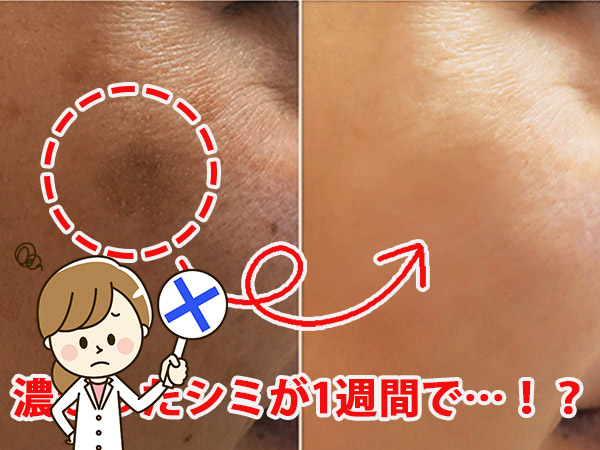 クロノセル シミ 消えない